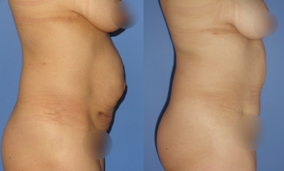 Abdominoplastia_dr_pedro_felipe_roa